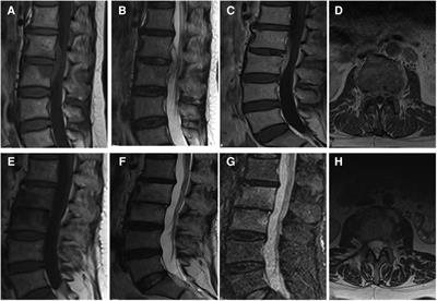 The effectiveness of percutaneous endoscopic lumbar discectomy combined with external lumbar drainage in the treatment of intervertebral infections